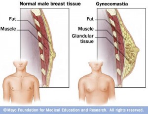 gynecomastia-300x231.jpg
