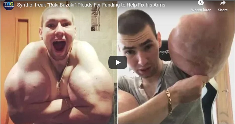 Synthol Kid gets his arms drained 