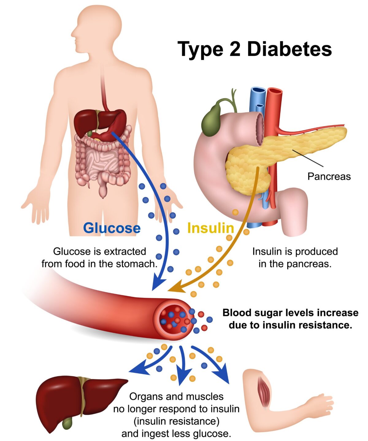 Breathtaking How Does Type 2 Diabetes Happen Capture in 4K Breathtaking How Does Type 2 Diabetes Happen Capture in 4K